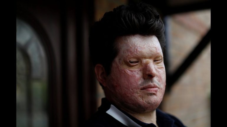 Acid Attacks: Hell In A Bottle